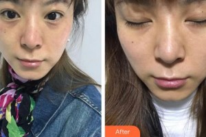 福州格萊美醫(yī)療美容醫(yī)院黃林玉整形價格表附超激光美膚祛斑案例展示
