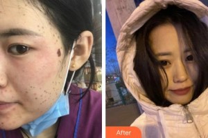 福州愛美爾整形美容醫(yī)院謝楠整形價格表附超激光美膚祛斑案例展示