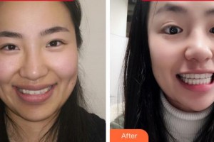 福州維樂(lè)口腔門診部郭淑蘋整形價(jià)格表附隱形矯正案例展示