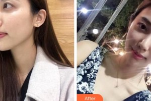 福州市第八人民醫(yī)院整形美容科徐典雄整形價(jià)格表附面部脂肪填充案例展示