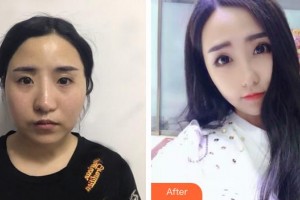 福州匯美整形美容醫(yī)院徐俊偉整形價(jià)格表附埋線提升提升案例展示