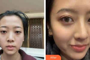 福州格萊美醫(yī)療美容醫(yī)院周秀峰整形價格表附鼻部手術案例展示