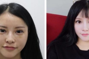 福州海峽美容醫(yī)院李麗強整形價格表附切開雙眼皮案例展示