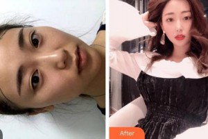 福州海峽美容醫(yī)院吳淑芬整形價格表附發(fā)際線案例展示