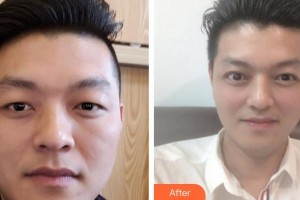福州美貝爾醫(yī)療美容門診部張曉棠整形價格表附即變男神，無關痛癢案例展示