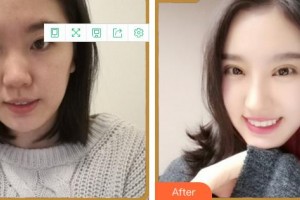 福州眼科醫(yī)院葉向彧整形價格表附眼部綜合案例展示