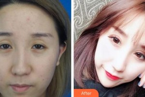 福州眼科醫(yī)院張琦整形價(jià)格表附切開雙眼皮案例展示