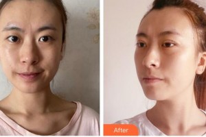 福州眼科醫(yī)院黃春艷整形價(jià)格表附切開雙眼皮案例展示