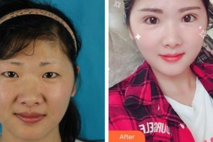 福州東南眼科醫(yī)院劉利娟整形價(jià)格表附切開雙眼皮案例展示