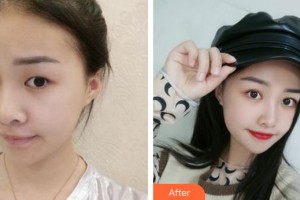 福州東南眼科醫(yī)院楊蘊華整形價格表附眼部手術案例展示