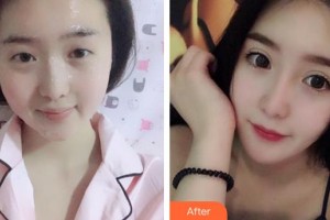 福州東南眼科醫(yī)院趙廣愚整形價(jià)格表附雙眼皮+開內(nèi)眼角案例展示