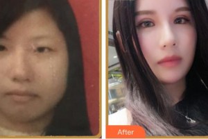 福州東南眼科醫(yī)院童繹整形價格表附眼部整形案例展示