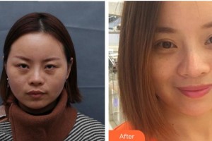 福州東南眼科醫(yī)院劉進清整形價格表附重瞼修復(fù)術(shù)+上瞼提肌矯正術(shù)案例展示