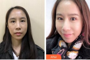 福州東南眼科醫(yī)院林興中整形價格表附不開刀去眼袋+淚溝填充+收緊案例展示