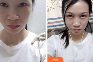 福州東南眼科醫(yī)院徐淑男整形價格表附眼部修復(fù)案例展示
