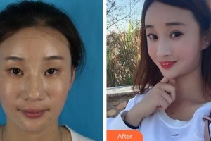 福州東南眼科醫(yī)院伏冰冰整形價格表附切開雙眼皮案例展示