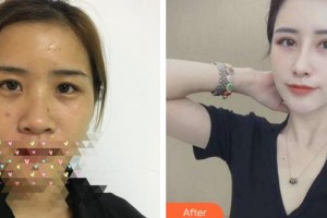 福州東南眼科醫(yī)院陳元整形價格表附眼部手術(shù)、鼻部手術(shù)，多方面部脂肪填充案例展示