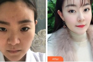 福州東南眼科醫(yī)院賀琴整形價(jià)格表附切開雙眼皮案例展示