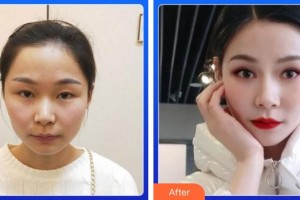 福州東南眼科醫(yī)院肖國武整形價(jià)格表附5s重瞼術(shù)+超微創(chuàng)開內(nèi)眥案例展示