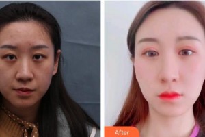 福州東南眼科醫(yī)院吳國瑋整形價(jià)格表附埋線重瞼修復(fù)+內(nèi)眥開大術(shù)案例展示