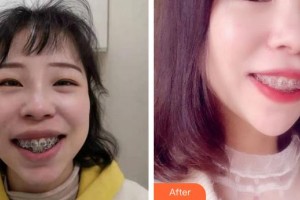 福州維樂口腔門診部陳獻(xiàn)禮整形價(jià)格表附牙綜合案例展示