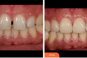 福州弗麗嘉口腔門診部陳輝整形價(jià)格表附牙齒貼面案例展示