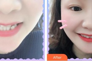福州科爾口腔門診部謝德榜整形價(jià)格表附牙齒矯正案例展示
