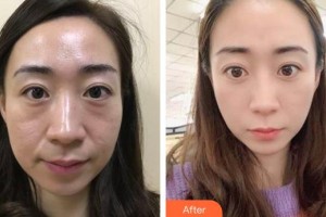 福州東南眼科醫(yī)院陳波整形價(jià)格表附切開雙眼皮案例展示