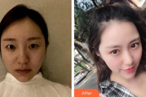 廈門張銘整醫(yī)療美容診所林平整形價格表附洛麗塔綜合美眼案例展示