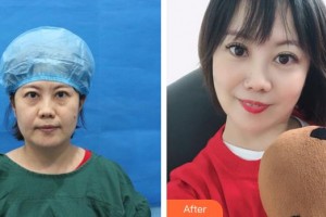 袁純新整形價格表附不開刀祛眼袋+自體脂肪填充淚案例展示