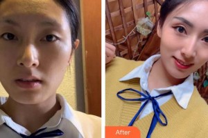 廈門莫琳娜醫(yī)療美容門診部張新合整形價格表附埋線提升案例展示