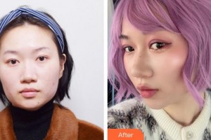 廈門修志夫整形美容醫(yī)院張寶譽整形價格表附埋線雙眼皮+去脂案例展示