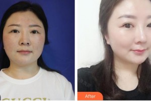 廈門莫琳娜醫(yī)療美容門診部邊大偉整形價格表附鼻修復(fù)改鼻案例展示