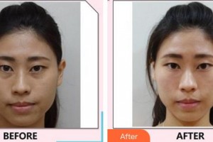 廈門莫琳娜醫(yī)療美容門診部宋維芳整形價(jià)格表附嫩膚案例展示