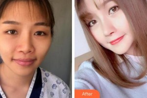 廈門莫琳娜醫(yī)療美容門診部王海濤整形價(jià)格表附鼻部手術(shù)案例展示