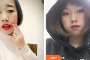 廈門海峽整形美容醫(yī)院袁靜明整形價(jià)格表附牙齒根管調(diào)節(jié)案例展示