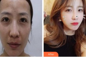 廈門海峽整形美容醫(yī)院王世爽整形價(jià)格表附激光美膚祛斑案例展示
