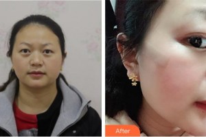 廈門大學(xué)附屬東南醫(yī)院燒傷整形科鄭慶亦整形價(jià)格表附面部疤痕修復(fù)案例展示