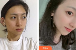 廈門大學(xué)附屬東南醫(yī)院燒傷整形科郭毅斌整形價(jià)格表附疤痕疙瘩案例展示