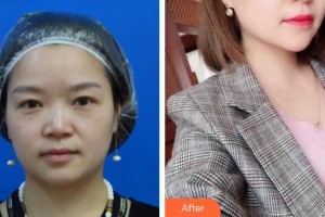 廈門海峽整形美容醫(yī)院尹衛(wèi)東整形價(jià)格表附鼻部整形案例展示