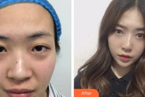 廈門莫琳娜醫(yī)療美容門診部陳麗萍整形價(jià)格表附硅膠隆鼻 全立體生態(tài)隆鼻案例展示