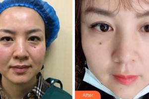 廈門莫琳娜醫(yī)療美容門診部吳曉紅整形價(jià)格表附不開(kāi)刀祛眼袋+淚溝填充案例展示