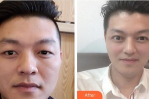 廈門莫琳娜醫(yī)療美容門診部林逸群整形價(jià)格表附即變男神，無(wú)關(guān)痛癢案例展示
