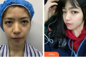 廈門莫琳娜醫(yī)療美容門診部阮南杰整形價(jià)格表附面部埋線提升案例展示