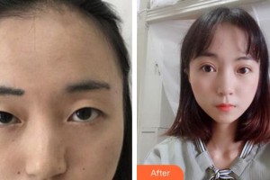 廈門莫琳娜醫(yī)療美容門診部游勝龍整形價(jià)格表附眼部綜合案例展示
