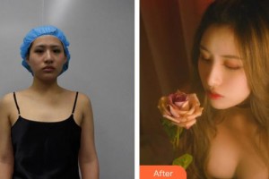 廈門莫琳娜醫(yī)療美容門診部李公昌整形價(jià)格表附胸部案例展示