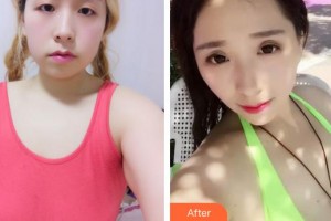 廈門銀河整形美容醫(yī)院羅海明整形價(jià)格表附胸部案例展示