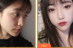 廈門銀河整形美容醫(yī)院劉喻筼整形價(jià)格表附面部提升案例展示