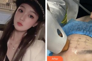 廈門新開元醫(yī)院整形美容中心郭友軍整形價(jià)格表附面部熱瑪吉案例展示