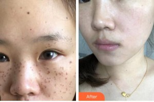 廈門臉博士整形醫(yī)院林達(dá)敏整形價格表附超激光美膚祛斑案例展示